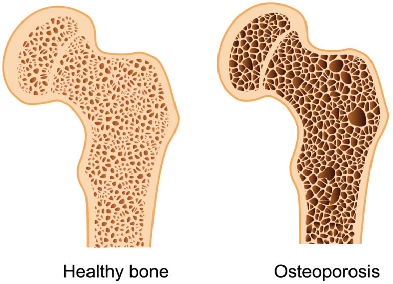 Dibujo de dos huesos cortados por la mitad uno normal y uno con osteoporosis. El enfermo tiene menos calcio